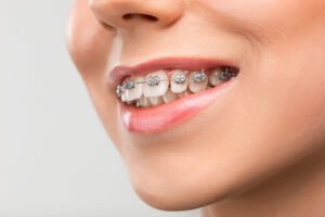 Malocclusione dentale: il ciuccio potrebbe essere la causa?